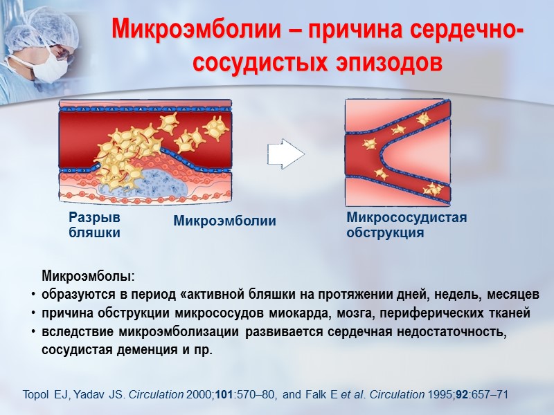 Микроэмболии – причина сердечно-сосудистых эпизодов Topol EJ, Yadav JS. Circulation 2000;101:570–80, and Falk E